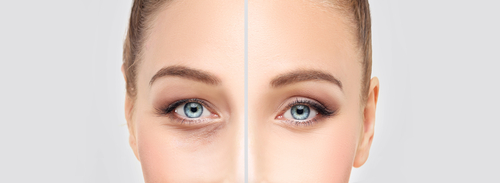 Eyelid Surgery Long Island